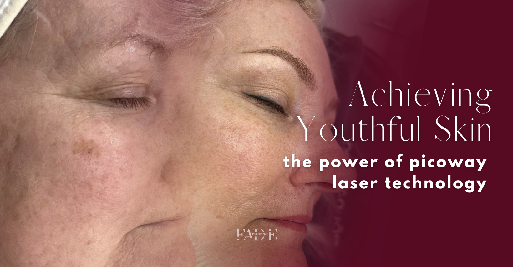 Achieving Youthful Skin The Power Of Picoway Laser Technology