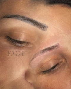 Laser Eyebrow Tattoo Removal Ottawa Ontario