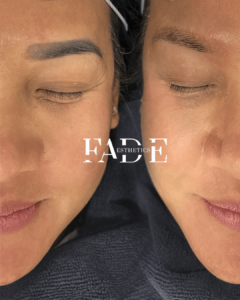 Fade Aesthetics Eyebrow Tattoo Removal First Session (1)