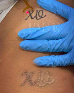 Laser Tattoo Removal First Session Ottawa Ontario